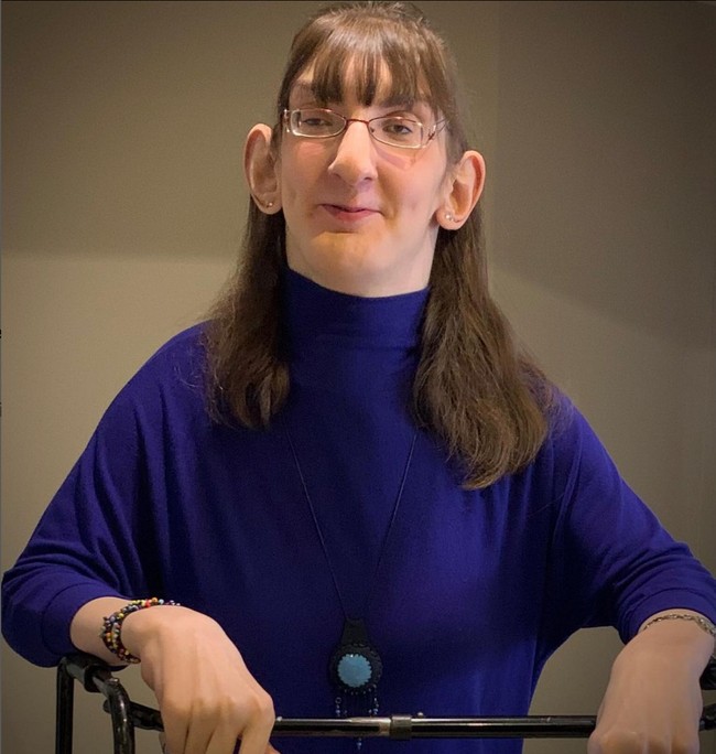 Namun Rumeysa Gelgi berhasil membuktikan bahwa kondisi langka tidak dapat menghalanginya untuk jadi orang sukses. Salah satunya dengan meniti karier di bidang IT. Foto: Instagram/@rumeysagelgi