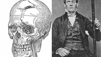 hineas Gage. Pria Yang Bertahan Dari Besi yang Menerobos Tengkorak. yFoto: Boredpanda