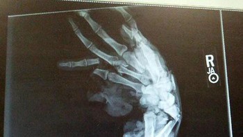 Hasil x-ray pasien, Foto: Boredpanda