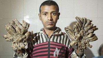 Pria ini terkena sindrom Treeman. Foto: Boredpanda