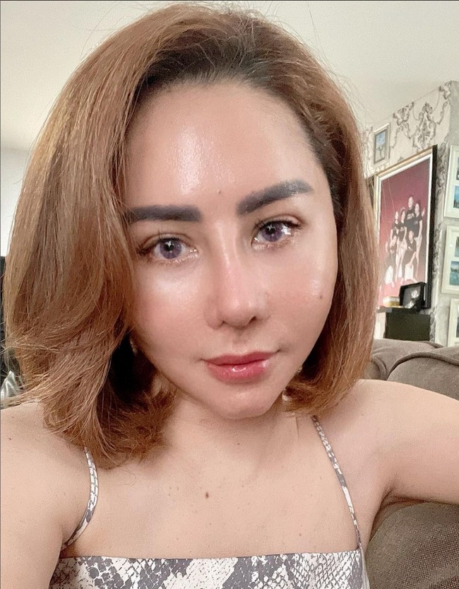 Femmy Permatasari juga masih merasakan nyeri di tulang iganya. Sebab sebagian kecil tulang iga diambil untuk ditambahkan pada bagian hidung. Foto: Instagram/@femmypermatasari