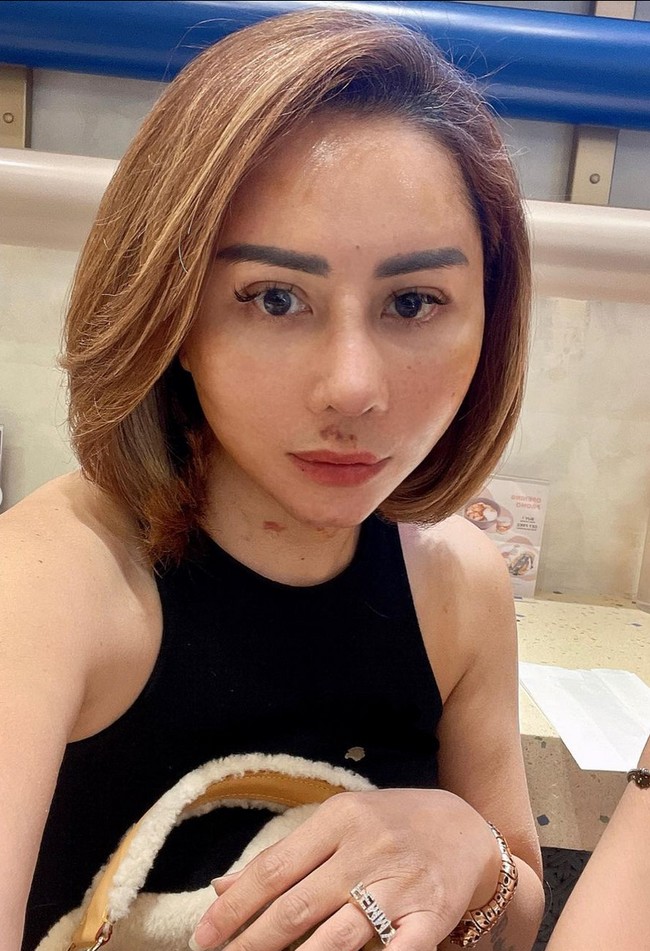 Sebelumnya Femmy Permatasari juga sudah memperlihatkan wajah 17 hari setelah operasi plastik. Saat itu wajahnya masih sangat bengkak dan terdapat memar di bagian hidung. Foto: Instagram/@femmypermatasari