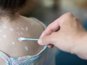 6 Cara Menghilangkan Bekas Cacar