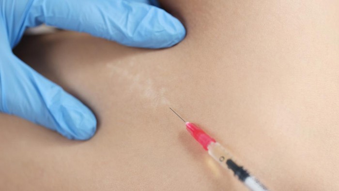 Doctor injecting medication in area of postoperative scar on skin closeup. Aesthetic medicine and plastic cosmetology for treatment of keloid scars concept