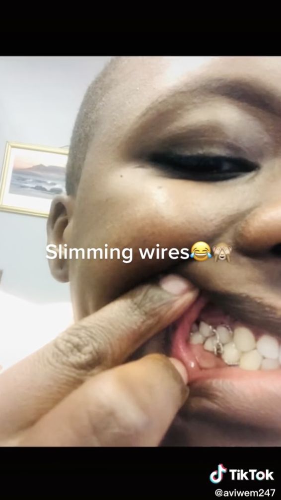 Extreme! This woman ties her teeth with a wire to lose weight