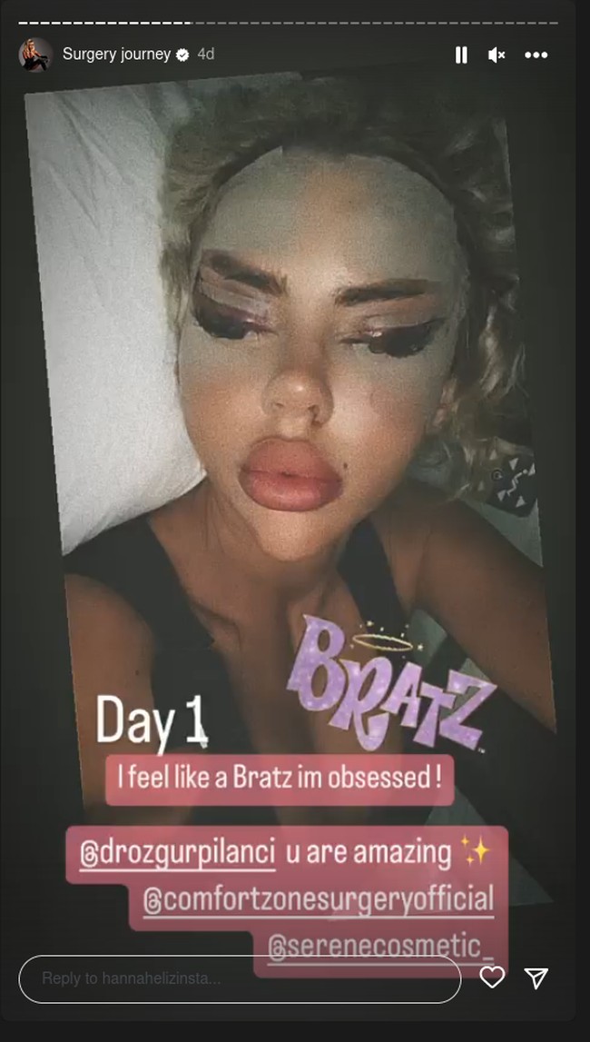 Hari pertama, aku merasa seperti Bratz, aku terobsesi, kata dalam foto yang menunjukan wajahnya yang bengkak karena baru saja menjalani tindakan.Foto: Instagram