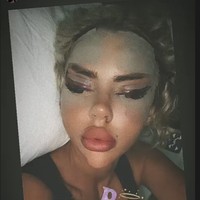 Hari pertama, aku merasa seperti Bratz, aku terobsesi, kata dalam foto yang menunjukan wajahnya yang bengkak karena baru saja menjalani tindakan.Foto: Instagram