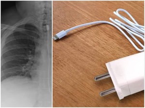 Alami Gangguan Makan Langka, Wanita Ini Doyan Makan Kabel Charger