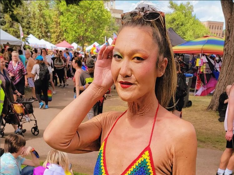 8 Potret Model dengan Kondisi Langka, Kulit Keriput di Usia 31 Tahun