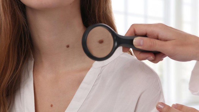 Doctor dermatologist examines birthmark of patient. Checking benign moles. Laser Skin tags removal
