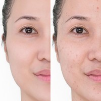 Serum untuk Menghilangkan Bekas Jerawat, Ini 6 Kandungan Aktif Paling Efektif