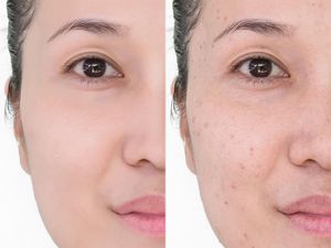 Serum untuk Menghilangkan Bekas Jerawat, Ini 6 Kandungan Aktif Paling Efektif