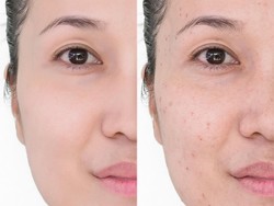 Serum untuk Menghilangkan Bekas Jerawat, Ini 6 Kandungan Aktif Paling Efektif