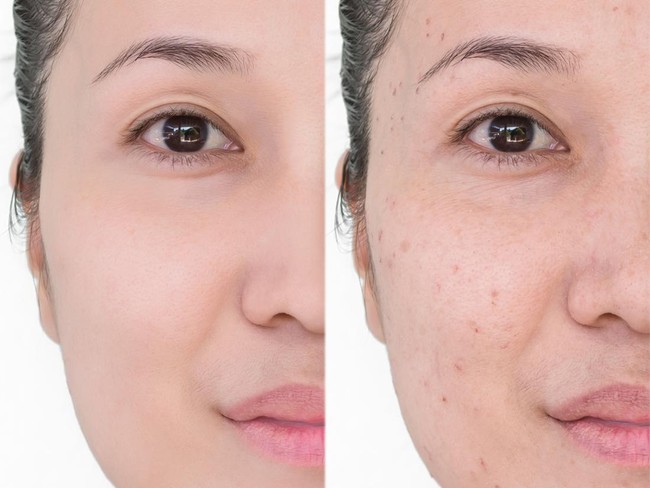 Cara Menghilangkan Noda Bekas Jerawat