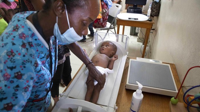 Seorang perawat memeriksa bayi yang menderita kekurangan gizi.