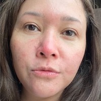 Maia Estianty cukup terbuka dengan perawatan kecantikan yang dijalaninya, mulai dari facial laser hingga suntik filler dan Botox. Belum lama ini musisi 46 tahun tersebut berbagi kondisi kulitnya yang mengidap rosacea. Foto: Instagram/@maiaestiantyreal