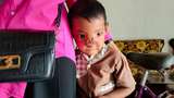 Mari Bantu Dilan, Bocah Penderita Tumor Hidung di Lampung Timur