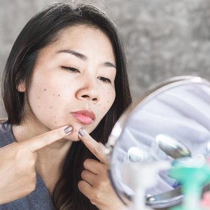 6 Cara Menghilangkan Jerawat dengan Cepat yang Bisa Dilakukan di Rumah 6 Cara Menghilangkan Jerawat dengan Cepat yang Bisa Dilakukan di Rumah