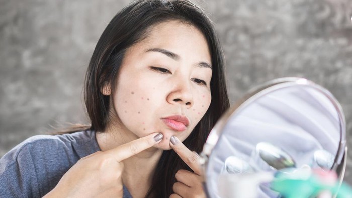 Asian woman having skin problem with acne face ,squeezing pimples with mirror