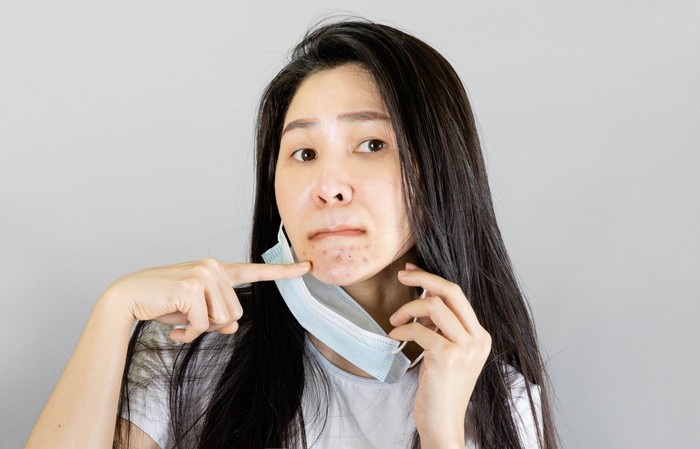 Young Asian woman wearing medical face mask and white t shirt point finger at pimple on chin. isolated on gray background,health care concept
