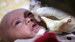 Vaksinasi Polio Kembali Dikebut usai Indonesia Tetapkan KLB