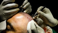 Dengan transplantasi rambut, para pria merasa semakin percaya diri untuk meningkatkan status sosialnya.  