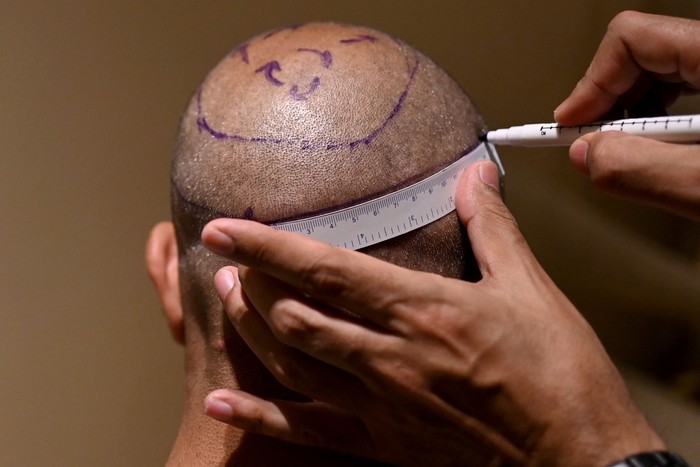 In this photograph taken on November 5, 2022, Dr. Mayank Singh makes hairline markings on the scalp of a hair transplant patient at Crown clinic in New Delhi. - All that balding Indian television executive Athar Rasheed wanted was to look handsome and get married. But the 30-year-old's seemingly harmless hair transplant went fatally wrong. Women have been judged on their appearance for millennia, but in an increasingly materialistic Indian society, men are also feeling pressure to look young and presentable for fear of losing their social standing.
 - To go with 'India-gender-health-social' FOCUS by Abhaya SRIVASTAVA (Photo by Sajjad HUSSAIN / AFP) / To go with 'India-gender-health-social' FOCUS by Abhaya SRIVASTAVA (Photo by SAJJAD HUSSAIN/AFP via Getty Images)