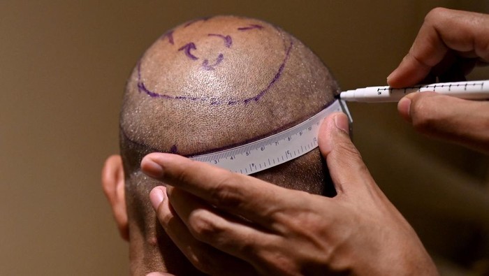 In this photograph taken on November 5, 2022, Dr. Mayank Singh makes hairline markings on the scalp of a hair transplant patient at Crown clinic in New Delhi. - All that balding Indian television executive Athar Rasheed wanted was to look handsome and get married. But the 30-year-olds seemingly harmless hair transplant went fatally wrong. Women have been judged on their appearance for millennia, but in an increasingly materialistic Indian society, men are also feeling pressure to look young and presentable for fear of losing their social standing.
 - To go with India-gender-health-social FOCUS by Abhaya SRIVASTAVA (Photo by Sajjad HUSSAIN / AFP) / To go with India-gender-health-social FOCUS by Abhaya SRIVASTAVA (Photo by SAJJAD HUSSAIN/AFP via Getty Images)