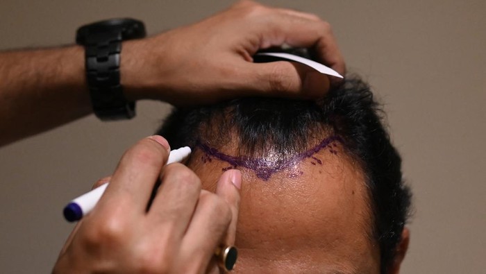 Ngeri, di India Transplantasi Rambut Berujung Maut In this photograph taken on November 5, 2022, Dr. Mayank Singh makes hairline markings on the scalp of a hair transplant patient at Crown clinic in New Delhi. - All that balding Indian television executive Athar Rasheed wanted was to look handsome and get married. But the 30-year-old's seemingly harmless hair transplant went fatally wrong. Women have been judged on their appearance for millennia, but in an increasingly materialistic Indian society, men are also feeling pressure to look young and presentable for fear of losing their social standing.
- To go with 'India-gender-health-social' FOCUS by Abhaya SRIVASTAVA (Photo by Sajjad HUSSAIN / AFP) / To go with 'India-gender-health-social' FOCUS by Abhaya SRIVASTAVA (Photo by SAJJAD HUSSAIN/AFP via Getty Images)