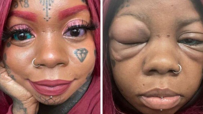 Viral Wanita Nyaris Buta gegara Nekat Tato Bola Mata