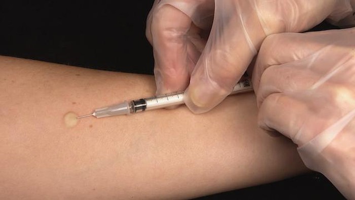 Tes mantoux