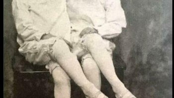 Si Kembar Yang Menginspirasi Tim Burton untuk karakater The Twins di Miss Pergerines Home For Peculiar Children Foto: Boredpanda