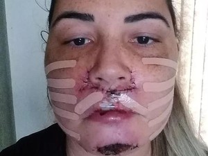 Wajah Wanita Ini Jadi Cacat Permanen Setelah Injeksi Filler Abal-abal