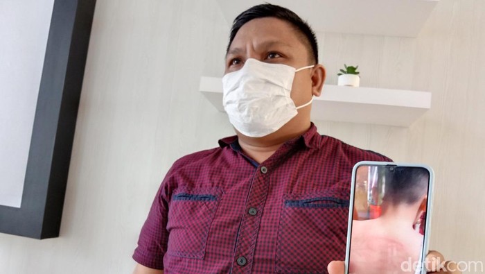 Ortu siswa menunjukkan foto luka lebam yang dialami anaknya diduga dianiaya guru di Manado, Sulut.