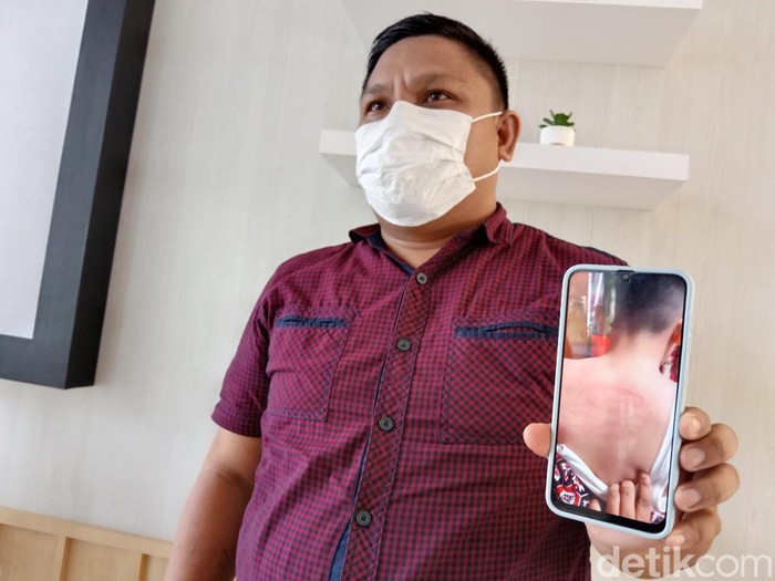 Ortu siswa menunjukkan foto luka lebam yang dialami anaknya diduga dianiaya guru di Manado, Sulut.