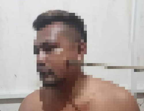 Korban pemanahan oleh OTK di Dompu. Anak panah tertancap di pipi. (IST)