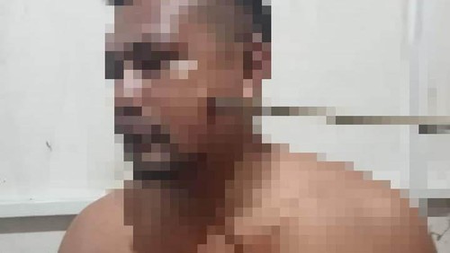 Korban pemanahan oleh OTK di Dompu. Anak panah tertancap di pipi. (IST)