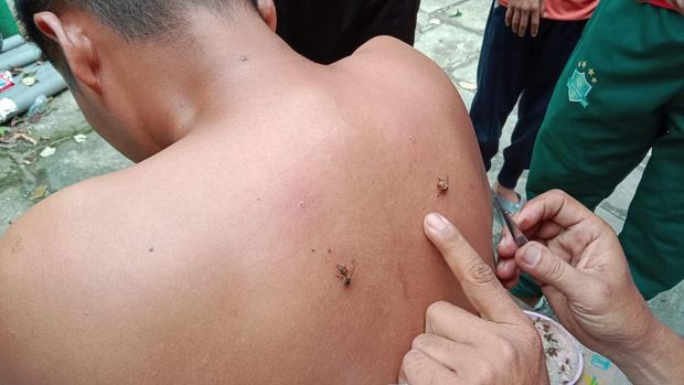 Salah seorang pasien yang sedang diterapi sengatan lebah. (Perdana Ramadhan/detikSumut).