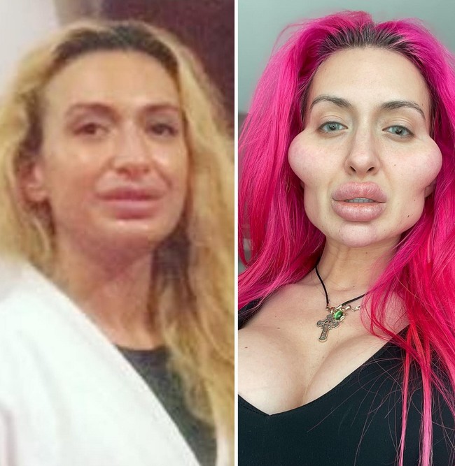 Tak hanya dipandang aneh, karena penampilannya ini Anastasia Pokreshchuk mengaku sering mendapat hujatan dari netizen. Tapi hal itu tidak menyurutkan niatnya untuk terus menginjeksi wajah dengan filler dan Botox. Foto: Instagram/@justqueen8888