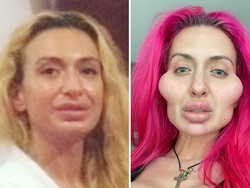 Foto: Transformasi Model dengan Pipi Terbesar, Before-After Suntik Filler