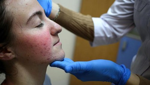 Ilustrasi Penyakit Lupus.