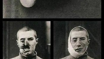  Prostesis (alat kesehatan untuk menggantikan bagian tubuh tertentu) wajah untuk seorang prajurit yang terluka dari Perang Dunia Pertama, 1916. Foto: Lostinhistorypics via Boredpanda
