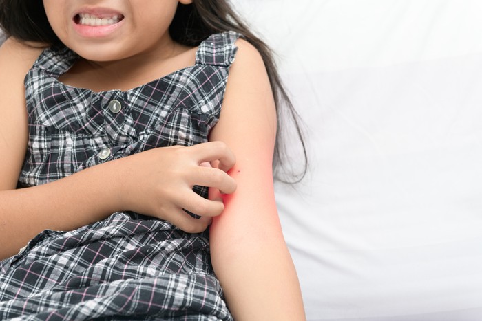 girl scratch the itch with hand , Concept with Healthcare And Medicine.