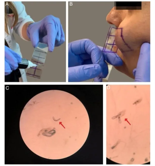 Proses pengambilan sampel tungai Demodex.
