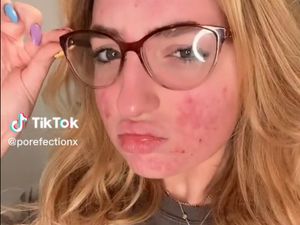 Ratu Kecantikan Berjerawat Diblokir TikTok, Kontennya Disebut Mengerikan