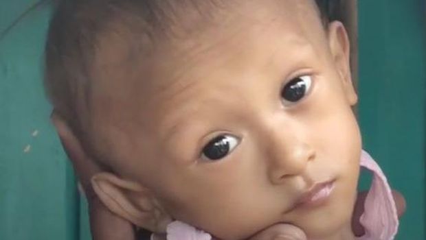 Salman Amarillah (2) salah satu anak yang divonis mengalami gizi buruk di Kecamatan Ketanggungan, Brebes, Jawa Tengah. Mari bantu donasi melalui berbuatbaik.