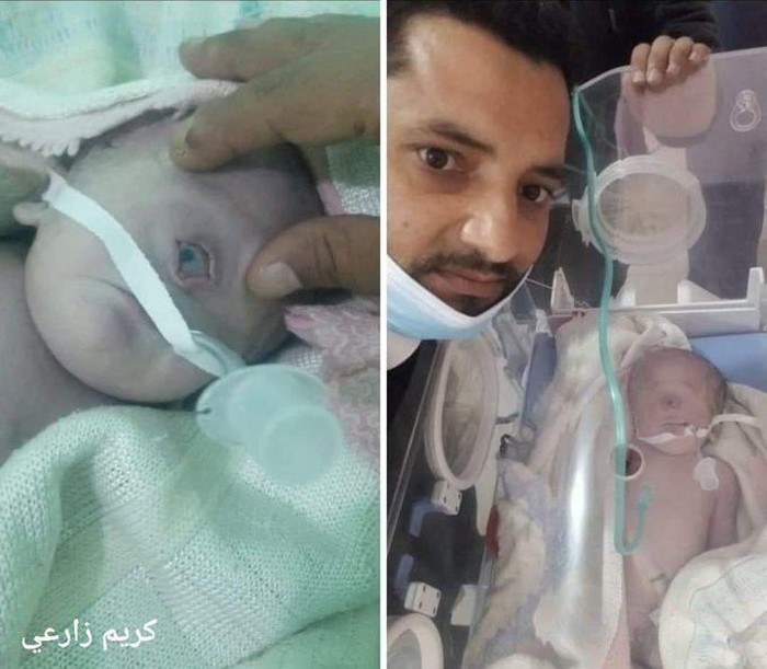 Bayi mata satu lahir di Yaman, namun hanya bisa bertahan selama tujuh jam.