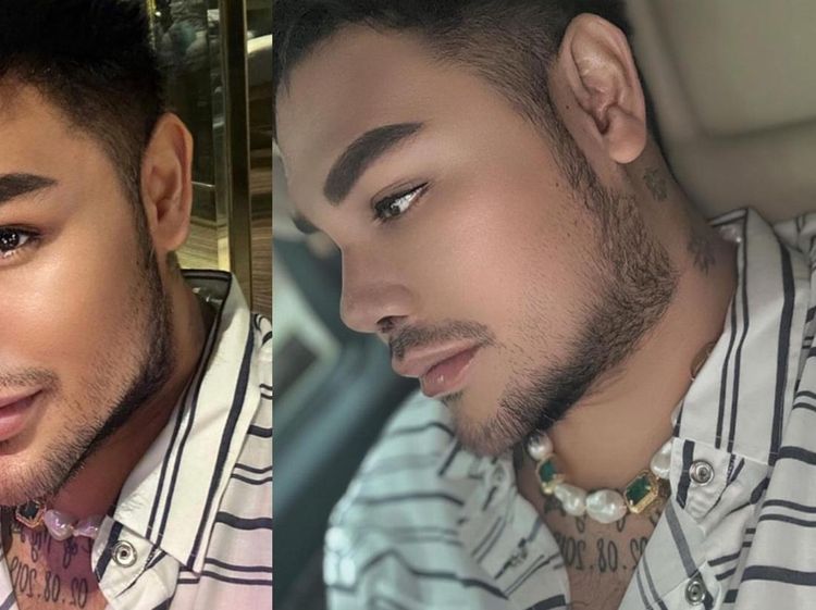 6 Potret Penampilan Hidung Baru Ivan Gunawan Pasca Operasi di Turki