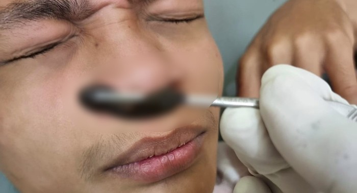 Warga Sukamakmur, Kabupaten Bogor, Jawa Barat, berinisial JM (22), dikejutkan dengan adanya lintah yang masuk ke dalam hidungnya. Lintah tersebut diketahui sebesar ibu jari.