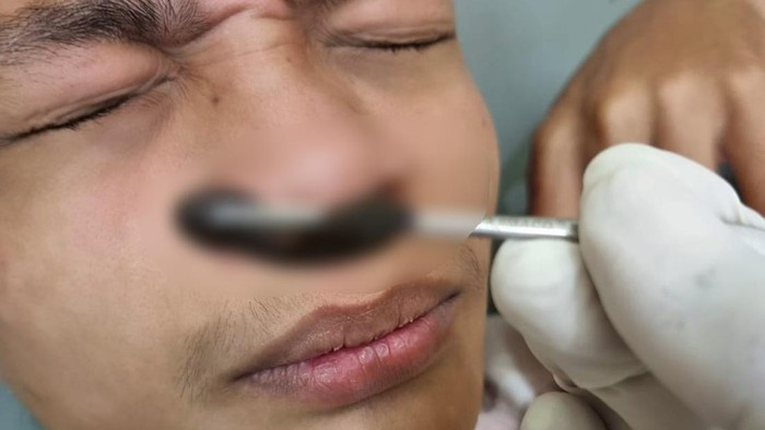 Warga Sukamakmur, Kabupaten Bogor, Jawa Barat, berinisial JM (22), dikejutkan dengan adanya lintah yang masuk ke dalam hidungnya. Lintah tersebut diketahui sebesar ibu jari.